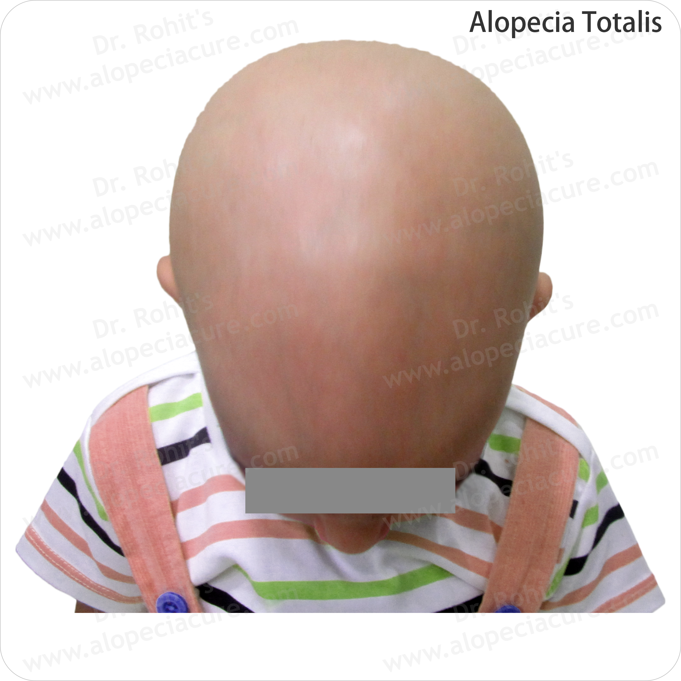 Alopecia Result